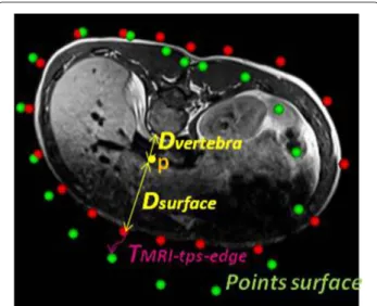 Figure 3 Ratio for weighted thin-plate spline. Calculation of the weighted thin-plate spline ratio based on the distance of the point p to be registed, the closest vertebra, and the surface of the torso