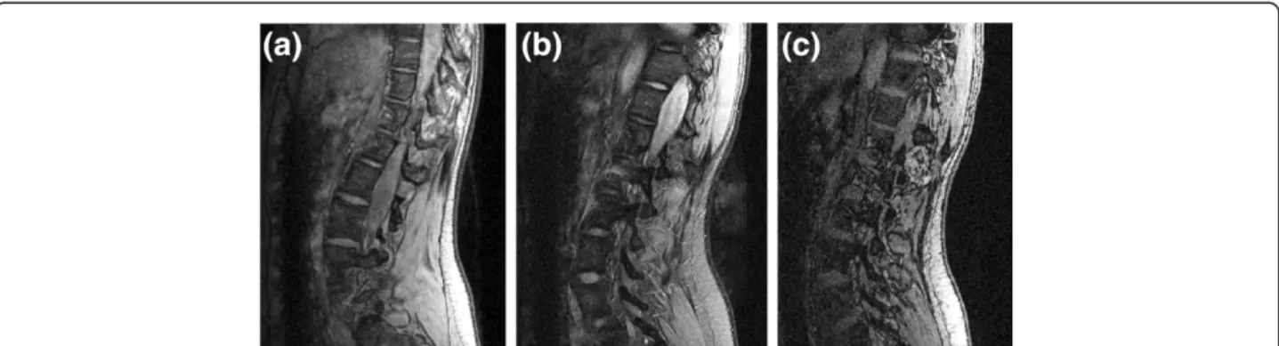 Figure 1 MRI acquisition protocols. Three different acquisition sequences for the same patient from the medium scoliotic severity group: (a) 3D MEDIC, (b) 2D Spin Echo, (c) 3D FISP.