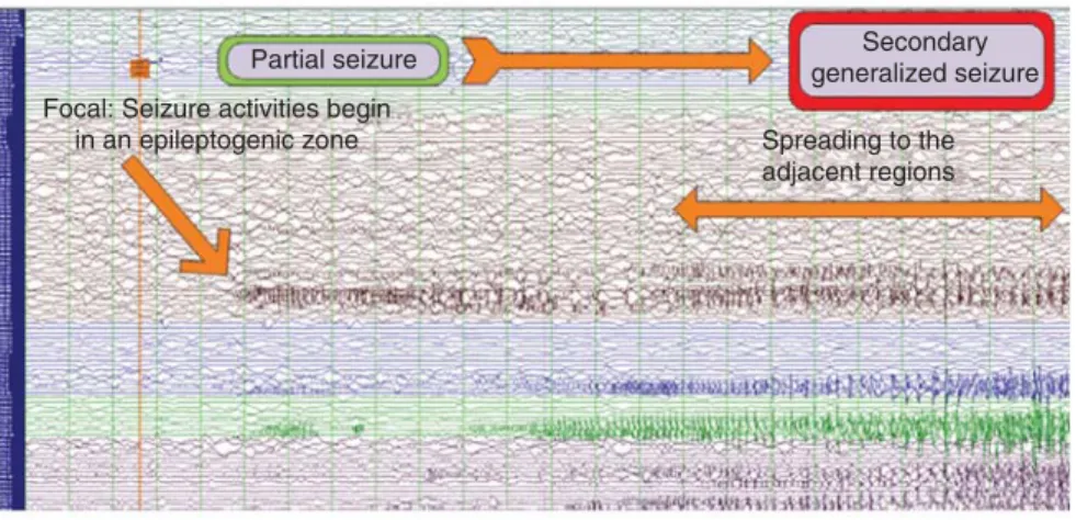 Figure 2. Intracerebral EFG recordings of a patient with refractory focal epilepsy [source: Centre Hospitalier de 1 ′ Université de Montréal].