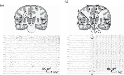Figure 1. Typical epileptic seizure (a) partial and (b) generalized seizures.