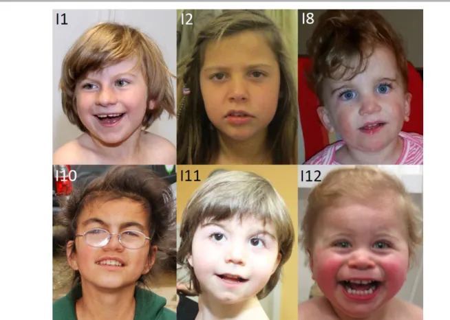Figure 2. Facial phenotypes of females with NAA10-related N-terminal-acetyltransferase deficiency