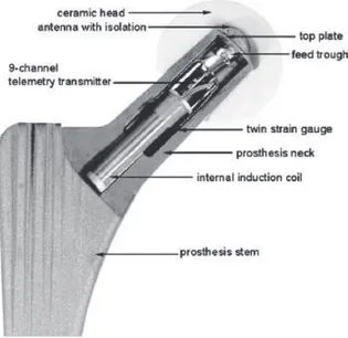 Figure 1.13 Prothèse instrumentée pour mesurer forces et moments dans une PTH (Damm et al