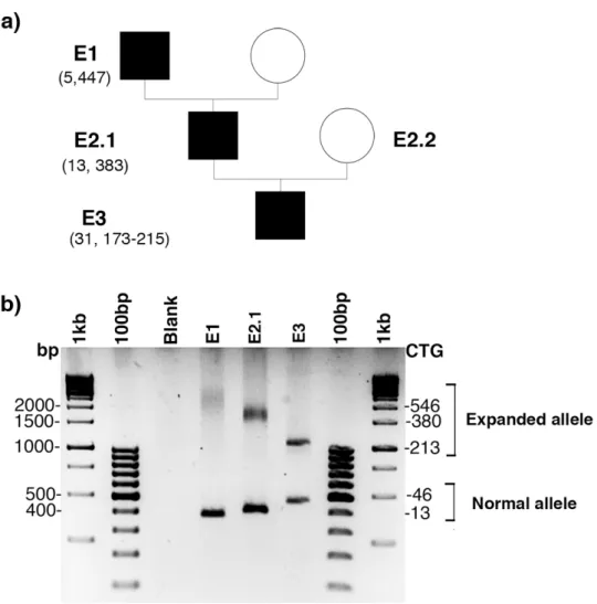 Figure 1. Atypical myotonic dystrophy type 1 (DM1) family E. (a) Part of family E pedigree