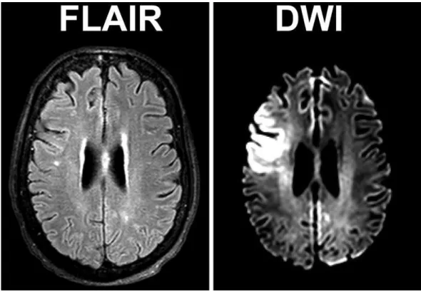 Figure 1.1: Comparison of FLAIR and dMRI. Comparison of FLAIR and dMRI (DWI stands for diﬀusion-weighted imaging) modalities in the detection of tissue changes in a patient with acute stroke (image courtesy of [Bokkers 2012]):