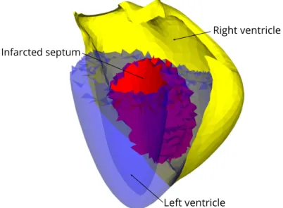 Figure 1.15: Example of an infarcted septum, in (red), in the heart geometry.