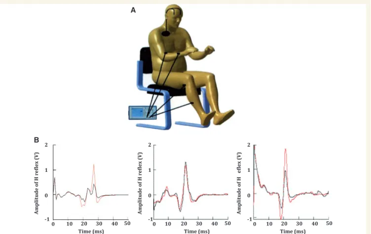 Figure 1 Experimental set up and examples of H-reflex recordings. (A) The patient is seated in an armchair with transcutaneous electrical stimulation on the median nerve and posterior tibial nerve, and recording electrodes on the flexor carpi radialis and 