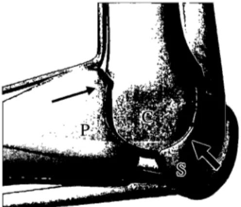 Figure  1. Contraintes biomécaniques principales s'exerçant sur une articulation métacarpo-