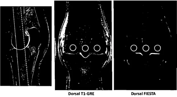 Figure  2.  Quantitative  assessment  of  subchondral  bone  density  in  the  palmar  metacarpal  region  using  dorsal  Tl-weighted gradient  recalled  (Tl-GRE) and  dorsal  3D T2*-weighted GRE FIESTA