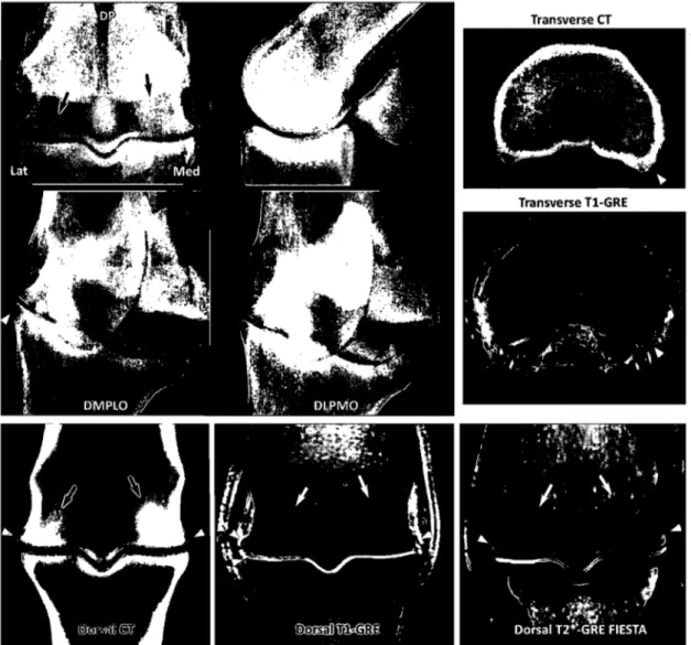 Figure 5. Imaging features  of osteoarthritis on corresponding CR,  CT and MRI images of the  same  left  metacarpophalangeal  joint