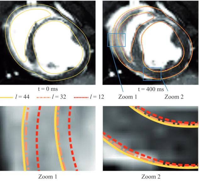 Figure 9: Comparison of observer contours with MR images at two stages for l = 12, 32, 44 (top) and zoomed views (bottom)