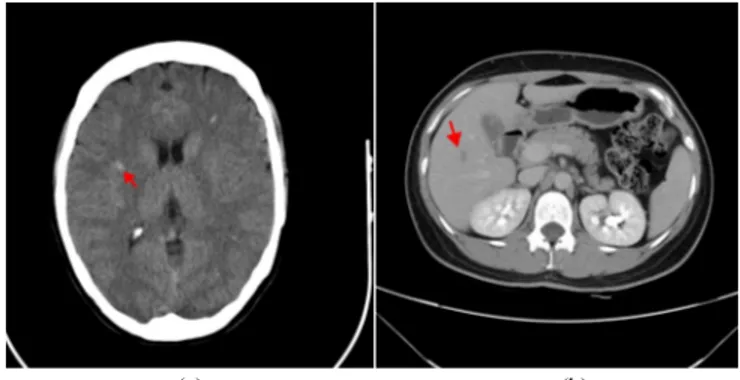 Fig.  1  A  cerebral  CT  image  of  a  multiple  sclerosis  (MS)  patient  (a)  and  an  abdominal CT image of a hepatic carcinoma patient (b)