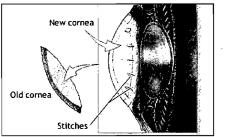 Figure 3 : Transplantation cornéenne transfixiante : technique chirurgicale 