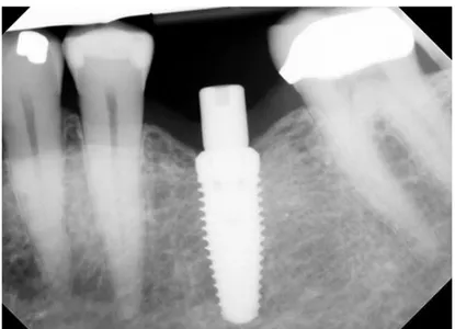 Figure 2.8: X-ray image of a dental bone implant integrated in the jawbone [174] 