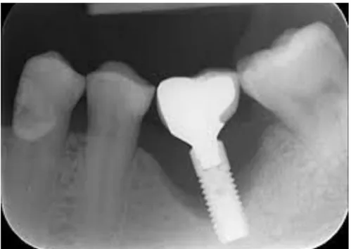 Figure  2.9:  Effect  of  peri-implantitis;  the  image  shows  bone  loss  caused  by  bacterial  inflammation