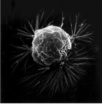 Fig. 8: SEM picture of a breast cancer cell 