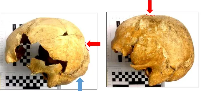 Fig. 6-7. Fenotipia cranica nel campione adulto femminile e maschile. In norma laterale sinistra: a  sinistra T4, con batrocefalia al lambda e squama occipitale a cuneo; a destra, T2 con clinocefalia  al bregma