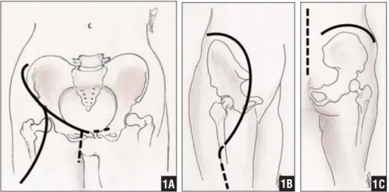 Figura  4.1.  Le  resezioni  anteriori  possono  richiedere  l'estensione  al  ramo  pubico  controlaterale  e  un'incisione  verticale  per  l'esposizione  dei  vasi  femorali  (A)