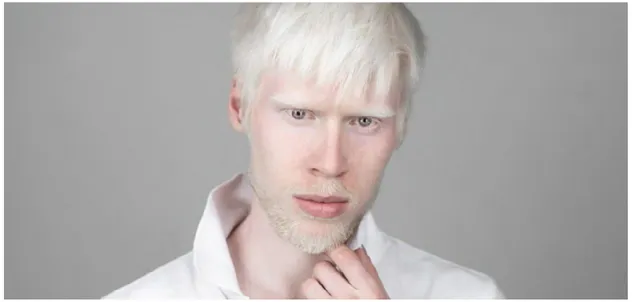 Figura 10: modello affetto da albinismo https://asiatravelguide.us/ 