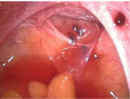 Figura 1: aspetto laparoscopico dei focolai endometriosici localizzati a livello del cavo di Douglas e del  legamento utero-sacrale destro