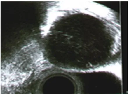 Figura 3: immagine ecografica di cisti endometriosica