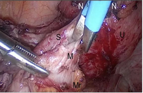 Figura 5:  Quadro intraoperatorio di shaving di nodulo endometriosico infiltrante la muscolaris  esterna del retto