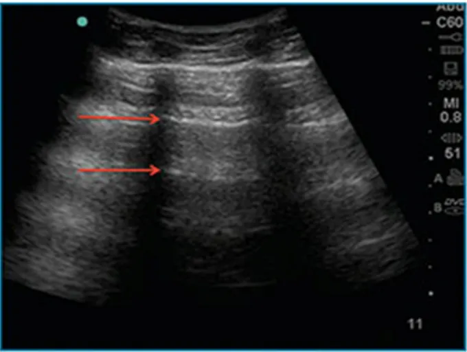 Figure 3 Ultrasound demostrating A-lines artifacts (red arrows), a repetitive reverberation artifact of pleura