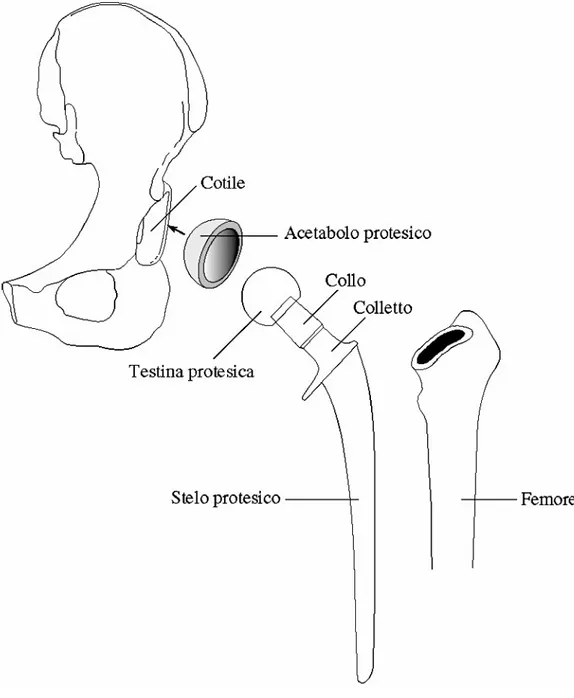 Figura  2.2:  Illustrazione  schematica  delle  componenti  di  una  protesi  totale  d’  anca:   componente  acetabolare  e  componente  femorale