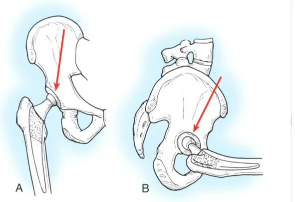 Figura 2.4: Le forze che producono la torsione dello stelo. (A) Le forze che agiscono sul piano  coronale dell'anca tendono a deviare lo stelo medialmente
