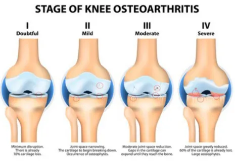 Figura 1.3 Gradi di artrosi rappresentati nel ginocchio. 