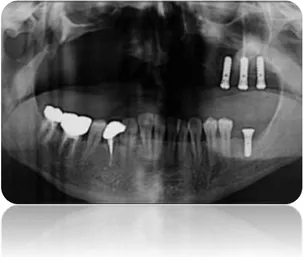 Figura 1  paziente oncologico con perdita della premaxilla  del quadrante 1 