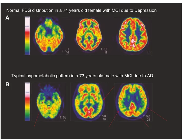 Figura 9. Distribuzione normale FDG-PET e pattern tipico di AD in due pazienti con compromissione cognitiva lieve (MCI)