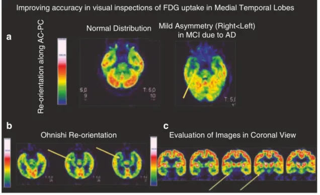 Figura 10. Valutazione del lobo temporale mediale su FDG-PET. Pannello a: immagini FDG-PET di un controllo sano (lato sinistro,  scansione normale) e di un paziente con AD (lato destro: lieve asimmetria in MTL con destra &lt;sinistra)