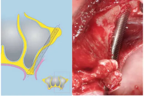 Fig. 8. Tipo 2 ZAGA 