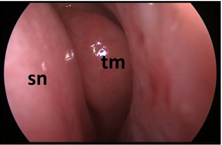 Fig. 29. Fossa nasale sinistra. Si vede medialmente il setto nasale(sn) e adiacente ad esso il turbinato medio(tm)