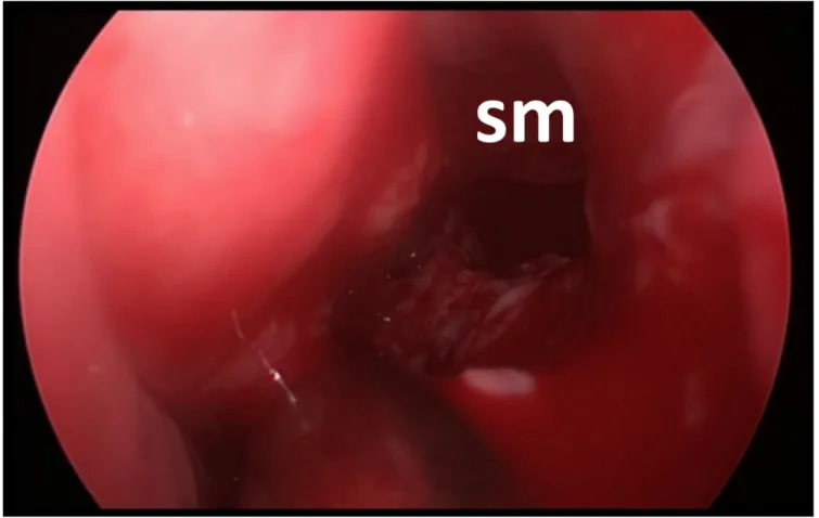 Fig. 33. Esecuzione di antrostomia media e visione dell’ostio ampliato che sbocca nel seno mascellare (sm)