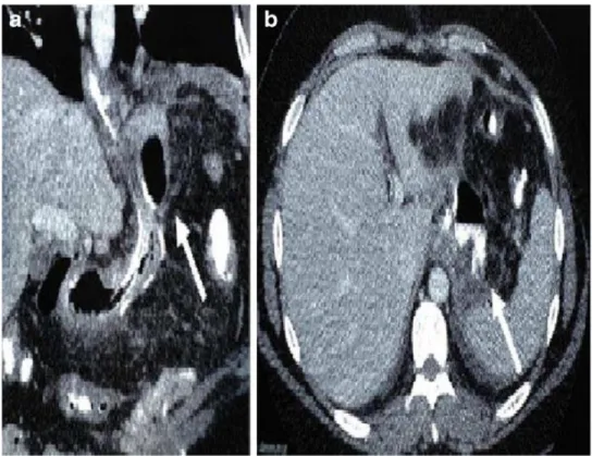 Fig. 8. TAC Addome che mostra una fistola con perdita di contrasto