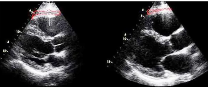 Figure  1.  Echocardiographic  assessment  of  epicardial  adipose  tissue.  The  left  side  is  an  end-systolic  image,  where  EAT  is  more  represented