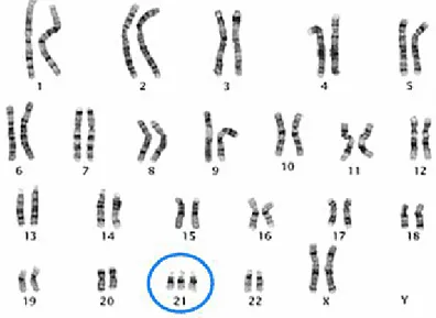 Figure 1. DS karyotype. This karyotype shows the classic appearance of trisomy 21. 