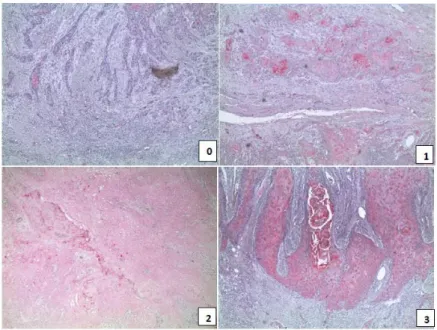 Figure 9. Representative pictures of IHC Nrp-1 expression in HNSCC specimens with the  intensity score: 0= negative; 1= weak; 2= moderate; 3= strong