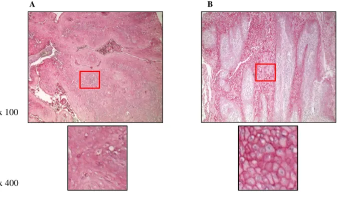Figure  10.  Representative  images  Nrp-1  staining  localization  (A.  cytoplasmic,  B