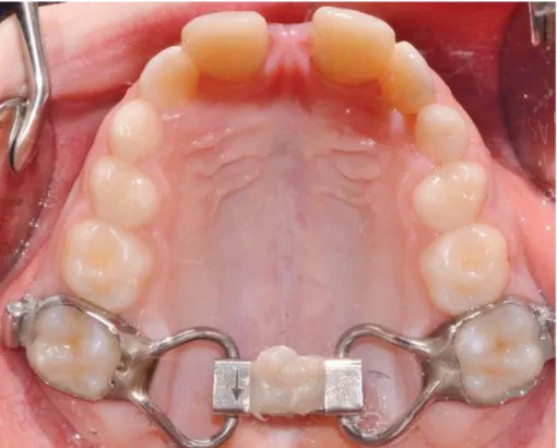 Figure 3.1. Two-band palatal expander at the end of the expansion phase 