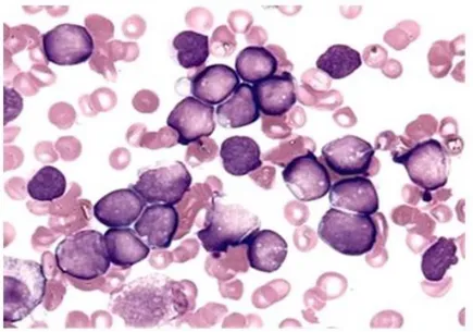 Figure  2.  Bone  marrow  aspirate  from  a  patient  diagnosed  with  B-ALL.  Nucleated  marrow 