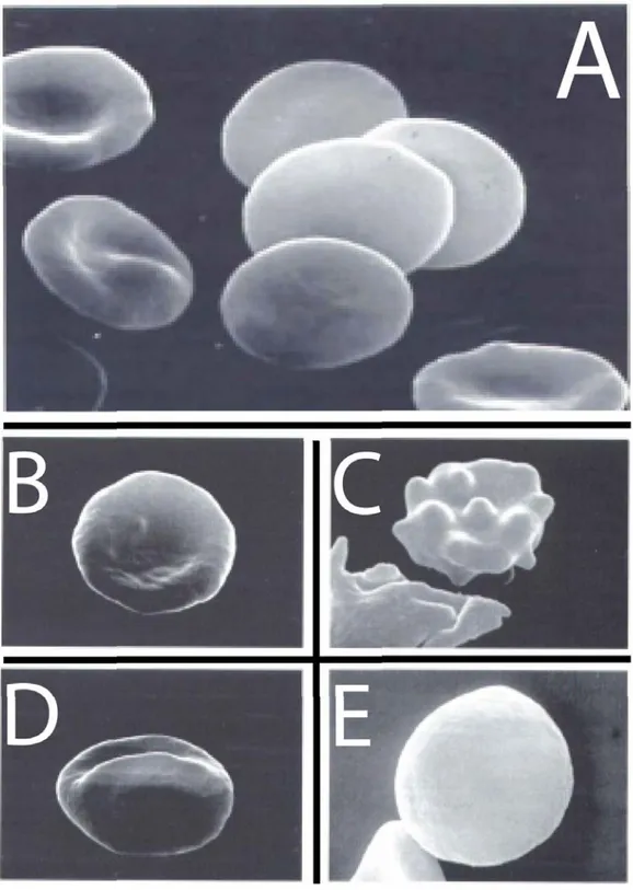 Figura 2.1 Eritrociti di sangue periferico visti al microscopio elettronico a scansione  (SEM): A, eritrociti normali; B, discocito; C, echinocito;  D, stomatocito; E, sferocito