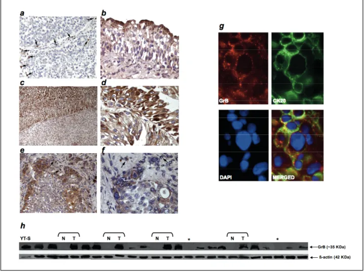 FIG.  13  Analisi  dell’espressione  di  GrB  in  tessuti  uroteliali  normali  e  neoplastici