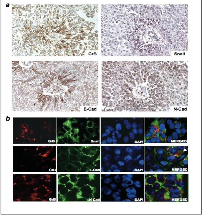 FIG.  14  Associazione  di  GrB  con  lo  stato  di  transizione  epitelio-mesenchimale  in  tessuti  di  carcinomi  uroteliali  (UCs)