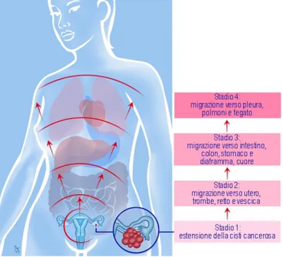 Figura 3.1: Rappresentazione schematica semplificata per visualizzare l’evoluzione e l’estensione del carcinoma ovarico agli altri organi.