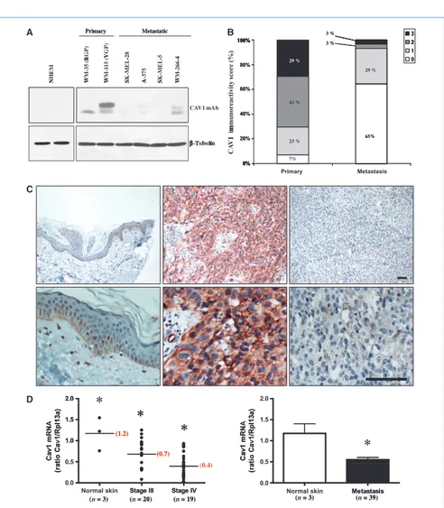 Figure 5. CAV1 expression is reduced in human metastatic melanoma cell lines and human tissue samples derived from metastatic lesions
