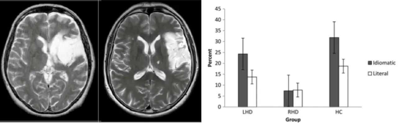 Fig. 3.1. Lesioni all’emisfero sinistro del cervello                            Fig. 3.2 Correlazione tra la produzione di formule e la  (qui evidenziato nella parte destra di ogni immagine)                    preservazione dell’emisfero destro (da Sidtis 