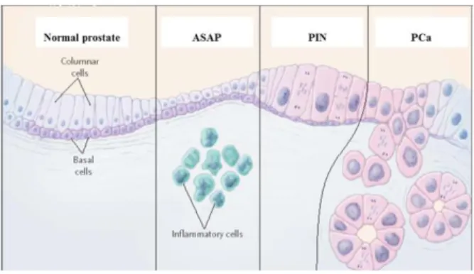 Figure 3. Pre-neoplastic and neoplastic forms of PCa. Nelson et al., 2003. 