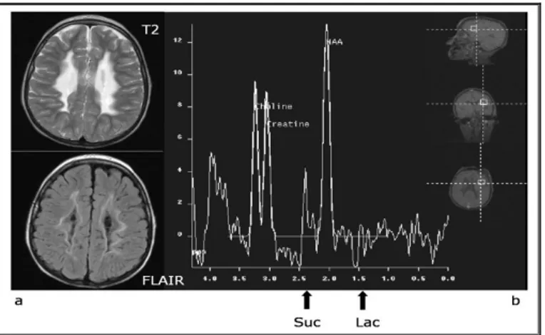 Fig. 7:  Patient 1(a) Brain MRI and (b) H +  MRSI  
